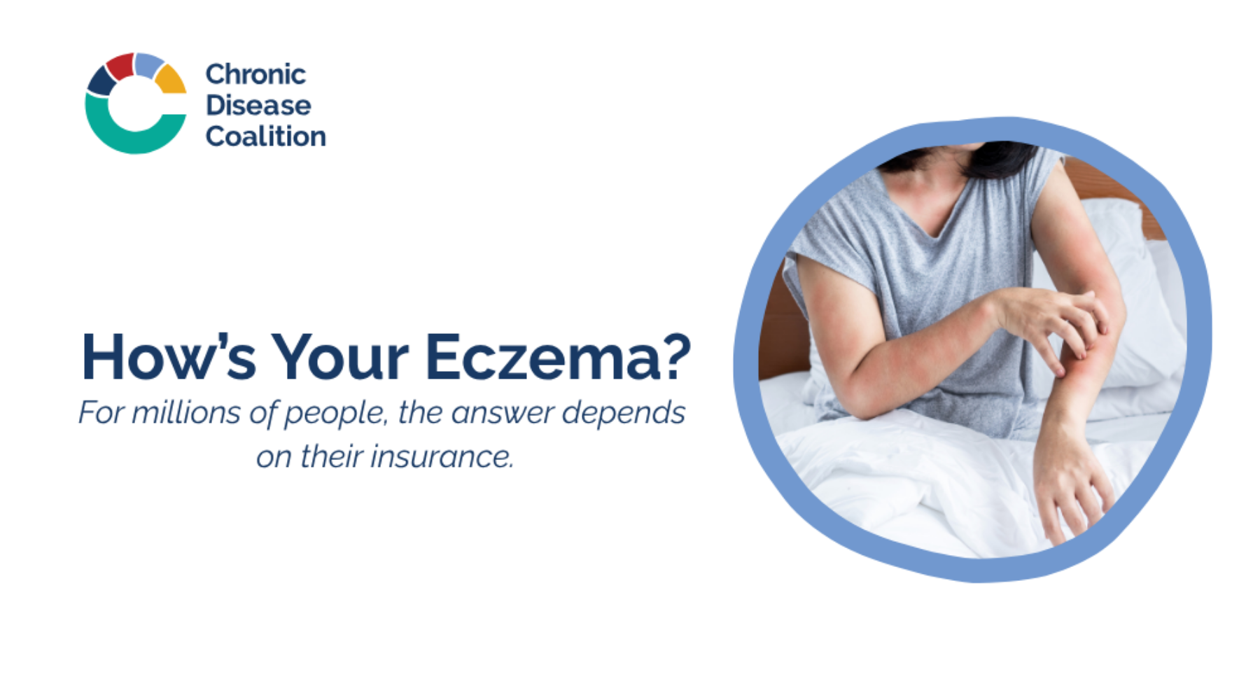 How is Your Eczema?